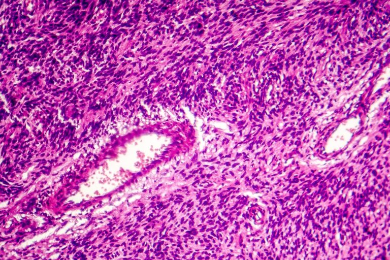 Fibrosarcoma en gatos