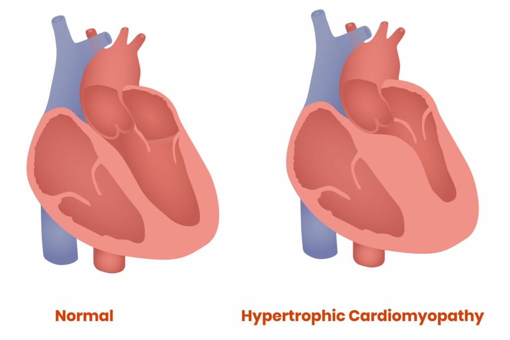 Cardiomiopatía hipertrófica felina (CMHF)
